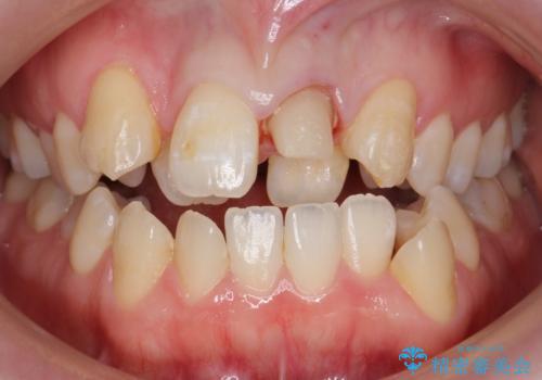 前歯が黒い セラミックで綺麗に 20代女性の治療中