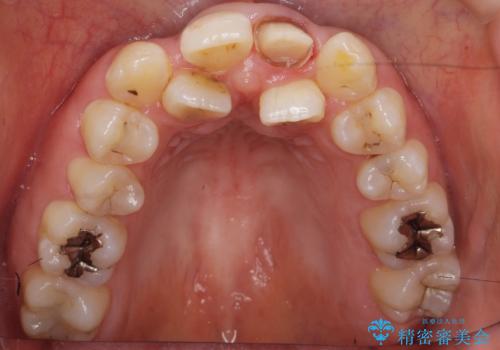 前歯が黒い セラミックで綺麗に 20代女性の治療中