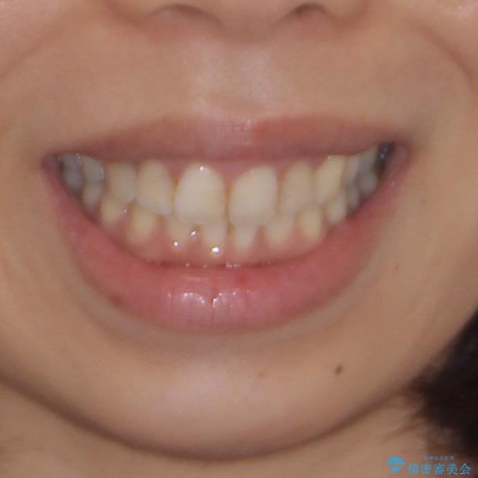 前歯の突出を軽減　インビザラインによる抜歯矯正の治療後（顔貌）
