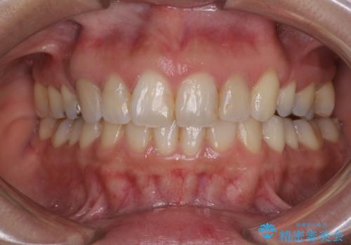 前歯の突出を軽減　インビザラインによる抜歯矯正の症例 治療後