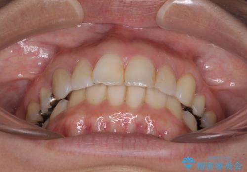 前歯の突出を軽減 インビザラインによる抜歯矯正の治療後