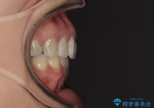 前歯の突出を軽減　インビザラインによる抜歯矯正