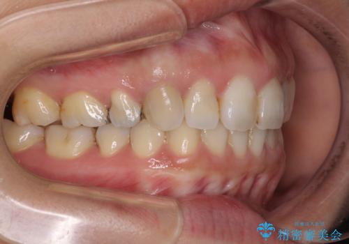 前歯の突出を軽減　インビザラインによる抜歯矯正の治療後