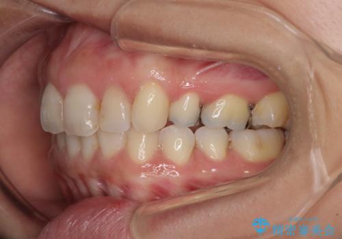 前歯の突出を軽減 インビザラインによる抜歯矯正の治療後