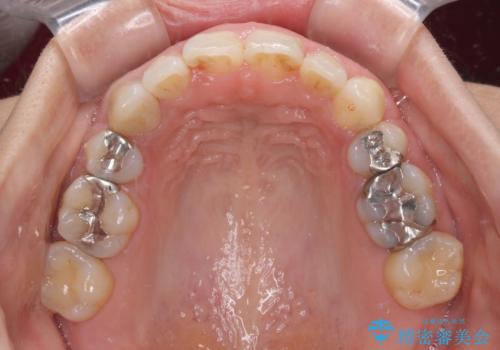 前歯の突出を軽減 インビザラインによる抜歯矯正の治療後