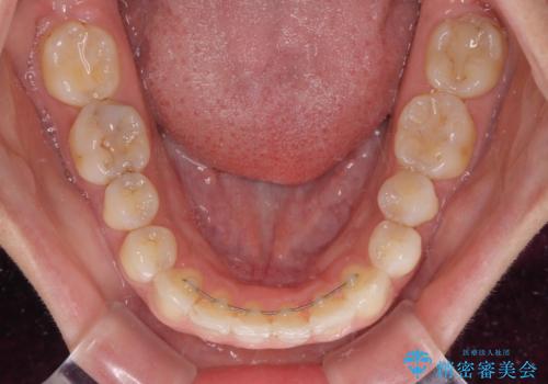 前歯の突出を軽減 インビザラインによる抜歯矯正の治療後