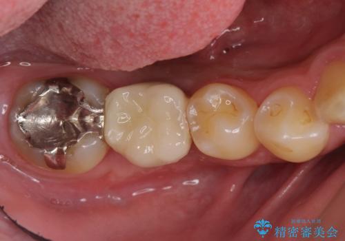 初めてのインプラント 手術は怖いので、寝ている間に終わりたいの治療後