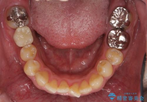 初めてのインプラント 手術は怖いので、寝ている間に終わりたいの治療後