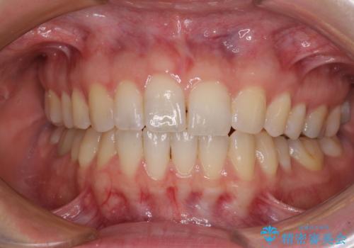 気になる上の歯を改善　インビザライン矯正の症例 治療後