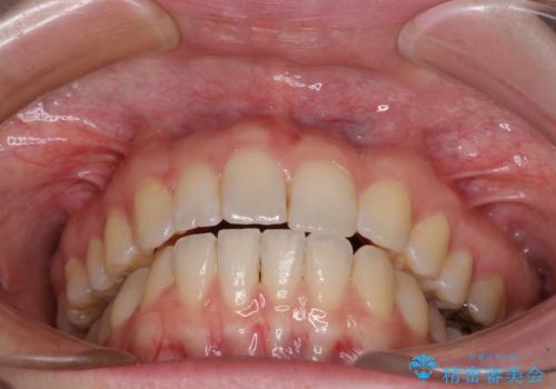 気になる上の歯を改善 インビザライン矯正の治療後