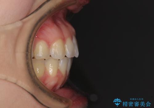 気になる上の歯を改善 インビザライン矯正の治療後
