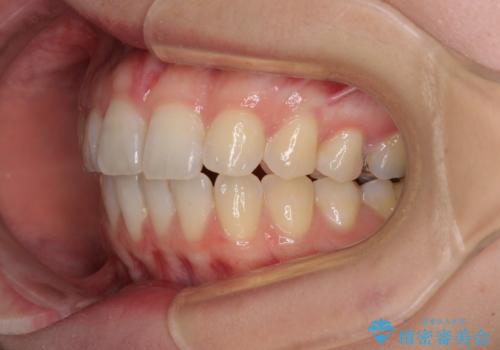気になる上の歯を改善 インビザライン矯正の治療後