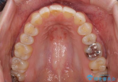 気になる上の歯を改善　インビザライン矯正の治療後