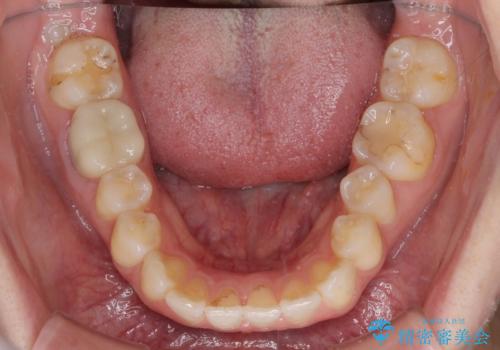 気になる上の歯を改善 インビザライン矯正の治療後