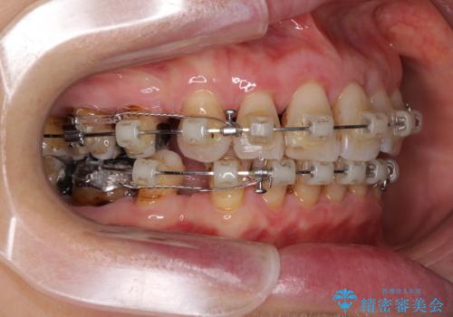 閉じにくい口元を改善したい ワイヤー装置での抜歯矯正の治療中