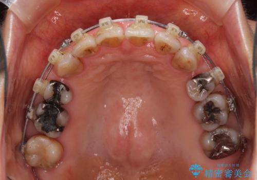 閉じにくい口元を改善したい ワイヤー装置での抜歯矯正の治療中