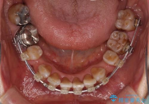 閉じにくい口元を改善したい ワイヤー装置での抜歯矯正の治療中