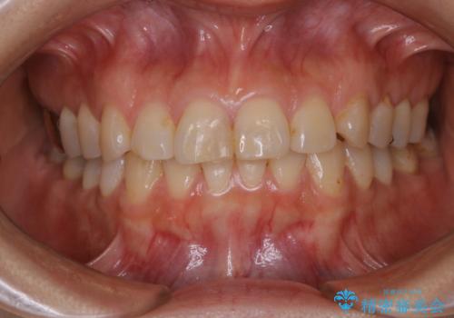 何度も欠けてしまう前歯を被せ物で治療の治療前