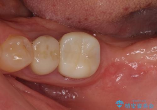 痛みを感じる奥歯 根管治療とインプラント治療の治療中
