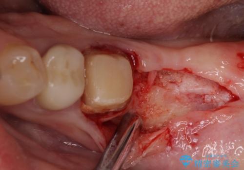 痛みを感じる奥歯 根管治療とインプラント治療の治療後