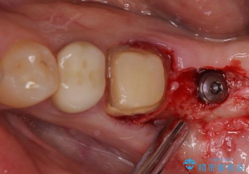 痛みを感じる奥歯 根管治療とインプラント治療の治療前