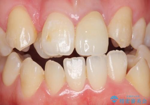 前歯が黒い セラミックで綺麗に 20代女性の治療後