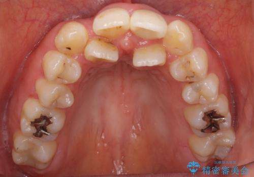前歯が黒い セラミックで綺麗に 20代女性の治療後