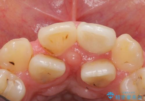 前歯が黒い セラミックで綺麗に 20代女性の治療後