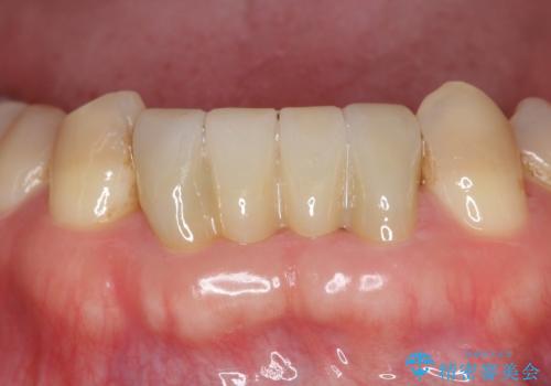 前歯の保険のブリッジ 欠けてしまったのをやり直したいの治療後