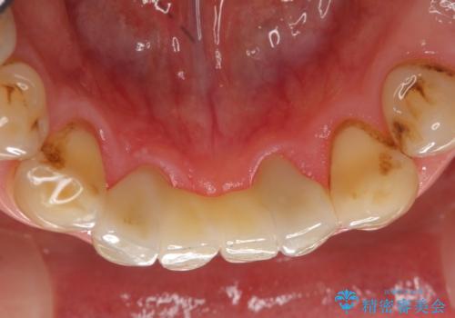 前歯の保険のブリッジ 欠けてしまったのをやり直したいの治療後