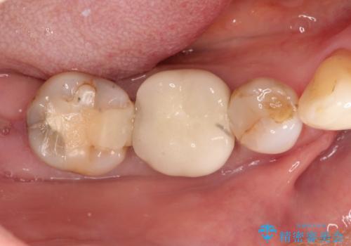 虫歯の治療　オールセラミッククラウンの症例 治療前