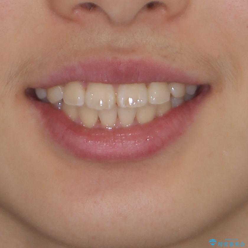 前歯のデコボコを短期間で治療 目立たないワイヤー矯正の治療後(顔貌)