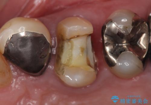 PGA(ゴールド)クラウン 脱離した銀歯の治療の症例 治療前