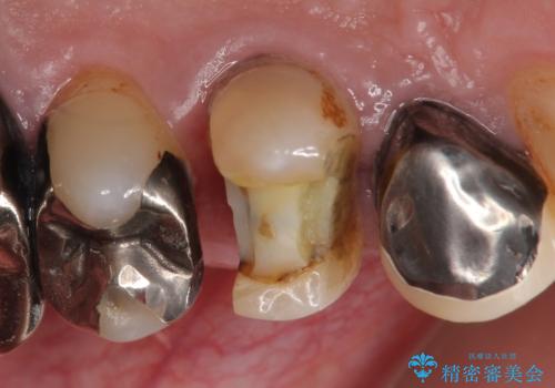 PGA(ゴールド)クラウン 脱離した銀歯の治療の治療前