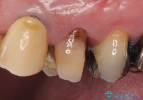 PGA(ゴールド)クラウン 脱離した銀歯の治療の治療前