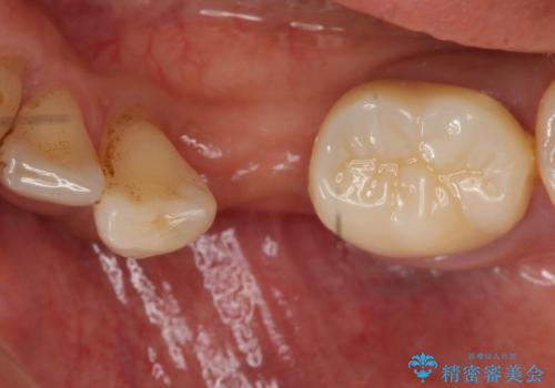 インプラント 左下奥歯の咬み合わせの改善の治療前