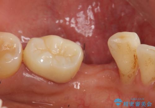 インプラント 左下奥歯の咬み合わせの改善の治療前