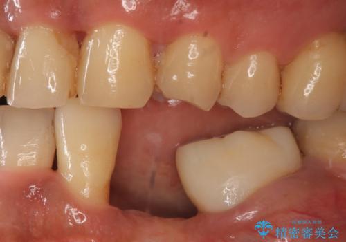 インプラント　左下奥歯の咬み合わせの改善の治療前