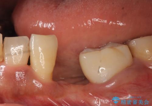 インプラント 左下奥歯の咬み合わせの改善の治療前