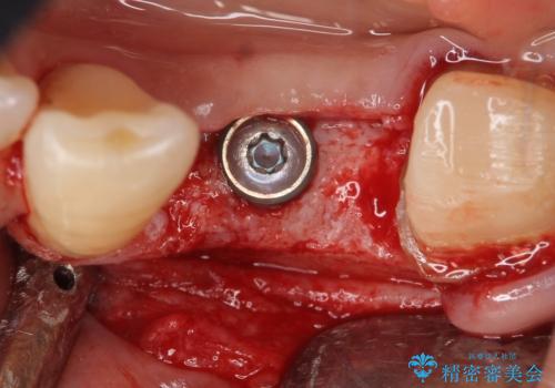 インプラント 左下奥歯の咬み合わせの改善の治療中