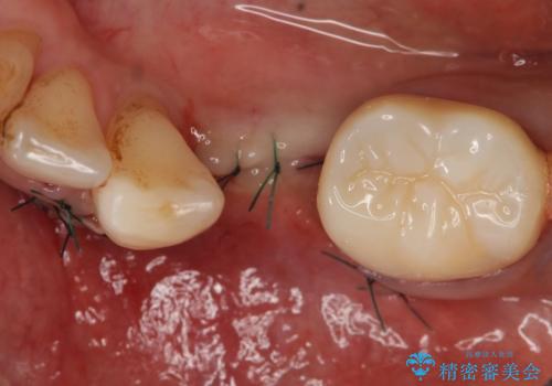 インプラント 左下奥歯の咬み合わせの改善の治療後
