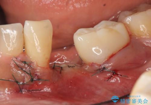 インプラント 左下奥歯の咬み合わせの改善の治療後