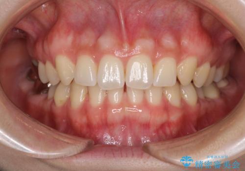 隙間だらけの歯列をきれいに インビザライン矯正とセラミック補綴治療の治療中