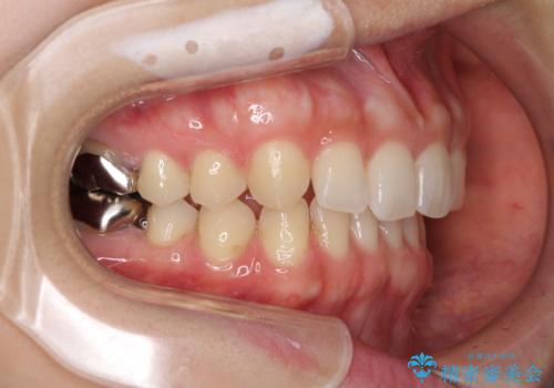 隙間だらけの歯列をきれいに インビザライン矯正とセラミック補綴治療の治療中