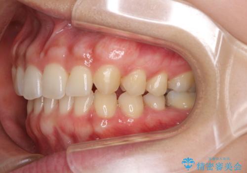 隙間だらけの歯列をきれいに インビザライン矯正とセラミック補綴治療の治療中
