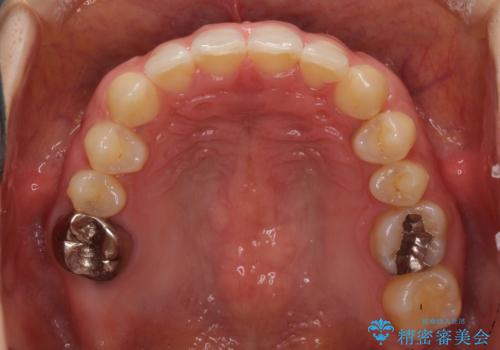 隙間だらけの歯列をきれいに インビザライン矯正とセラミック補綴治療の治療中
