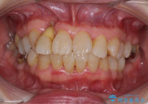 歯周病改善のための総合歯科治療の症例 治療前