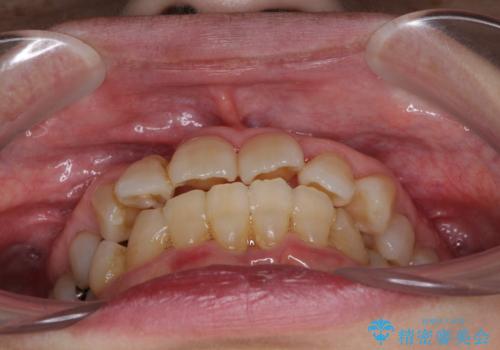 歯周病改善のための総合歯科治療の治療前