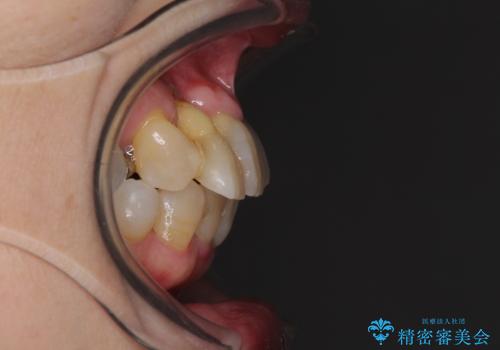 歯周病改善のための総合歯科治療の治療前