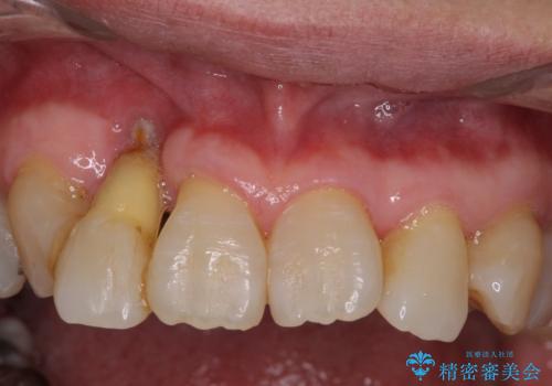 歯周病改善のための総合歯科治療の治療前